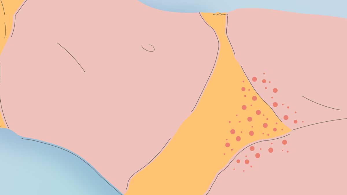 علائم حساسیت پوستی ناشی از لباس زیر + راهکارهای رفع و پیشگیری