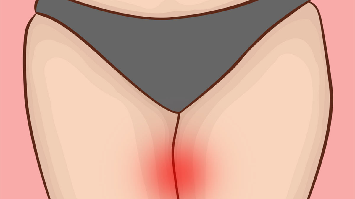 علائم ساییدگی ران ها | شورت مناسب برای جلوگیری